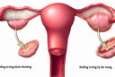 Đa nang buồng trứng đổi tên sau 90 năm - Nhiều phụ nữ từng bị hiểu sai