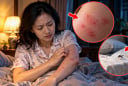 Mẩn ngứa đỏ mỗi đêm có phải bệnh không?