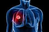 4 việc quan trọng phải làm ngay để ngăn ung thư phổi: Đừng để quá muộn rồi mới hối hận