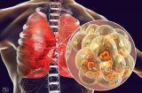 2 cách đơn giản của Đông y để chăm sóc phổi hiệu quả, giúp phổi sạch bong, thải hết độc cơ thể