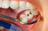 Thấy răng xuất hiện điểm 'lạ' này cần đi kiểm tra càng sớm càng tốt, chớ vội coi thường