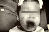 Nghịch cắn dây điện, bé gái 2 tuổi bị bỏng nặng vùng miệng