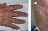 Đây là 5 dấu hiệu điển hình trên da người mắc Covid-19, mọi người cần chú ý