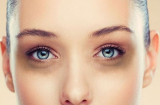 Thâm quầng mắt là dấu hiệu của 5 vấn đề sức khỏe chớ nên bỏ qua