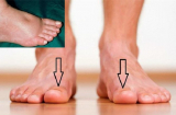 Muốn biết thận khỏe mạnh hay không, cứ nhìn vào 5 điểm ở bàn chân là rõ