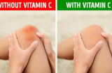 5 dấu hiệu cho thấy cơ thể đang thiếu vitamin C cần bổ sung ngay