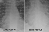 Bác sĩ chỉ điểm khác biệt đầy kinh ngạc khi so sánh ảnh chụp phổi bệnh nhân Covid-19 đã tiêm và chưa tiêm vắcxin