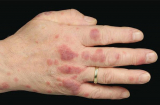 Nhờ vết mẩn đỏ trên tay người đàn ông phát hiện mình mắc bệnh hiểm nghèo: 6 dấu hiệu nhận biết