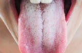 Tim khỏe hay không nhìn vào lưỡi sẽ rõ: Thấy 3 dấu hiệu này ở lưỡi thì đi khám ngay