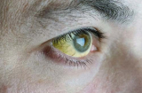 Lòng trắng của mắt có màu vàng có phải bị viêm gan? Có 3 loại khó chịu ở mắt thì kiểm tra gan sớm