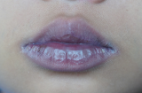 Chuyên gia cảnh báo F0 nhiễm Omicron thấy dấu hiệu này trên môi phải vào viện ngay lập tức