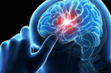Sáng ngủ dậy nếu thấy vùng đầu có 3 triệu chứng này hãy cảnh giác với cơn nhồi máu não