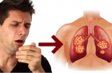 5 dấu hiệu sớm cảnh báo K phổi, nếu thấy có 1/5 cũng phải đi khám ngay
