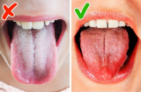 6 dấu hiệu ở lưỡi cho thấy cơ thể đang “kêu cứu”, đừng chủ quan với những biến đổi dù nhỏ