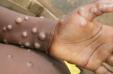 Số ca nhiễm đậu mùa khỉ đang tăng cao trên thế giới: Lây truyền qua đâu, triệu chứng thế nào?