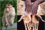 Tất cả những điều cần biết về bệnh đậu mùa khỉ: 4 đường lây truyền, 5 triệu chứng dễ nhầm lẫn