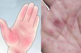 Thấy bàn tay có 1 trong 4 dấu hiệu: Cận thận K gõ cửa, số 2 nhiều người nhầm tưởng bệnh ngoài da