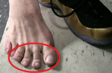 Ngón chân thứ hai dài hơn ngón cái, lớn lên sống bạc bẽo, liệu có đúng?