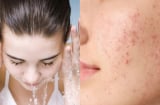 5 thói quen khiến lỗ chân lông to ra mà bạn không ngờ tới