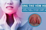 7 dấu hiệu K vòm họng: Số 1 không biết sớm khó mà chữa