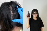 Trải nghiệm hết gàu ngứa của nữ sinh viên năm cuối: Kết quả bất ngờ từ dầu gội thảo dược?