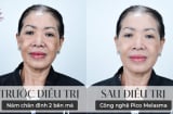 Pico Melasma - Bước tiến công nghệ vượt bậc giúp LG Clinic vươn tầm trong lĩnh vực điều trị nám da