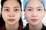 Căng da không phẫu thuật -Công nghệ 5.5.10: Vì sao trở thành xu hướng trẻ hóa được phụ nữ sau 40 tuổi lựa chọn?