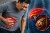 3 dấu hiệu cảnh báo viêm túi mật nặng
