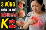 3 vùng trên cơ thể cảnh báo K đến sớm