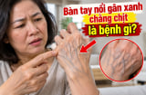 Bàn tay nổi gân xanh chằng chịt là bệnh gì?