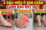 3 dấu hiệu ở bàn chân cảnh báo đột quỵ, số 1 cảnh báo cao