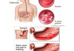 Viêm loét dạ dày tá tràng – Với phương thuốc hiệu nghiệm