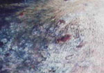 Bảo Thanh Đường - Điều trị dứt điểm bệnh viêm chân tóc