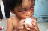 TP.HCM: Bé 3 tuổi bị mẹ và cậu đánh tím mắt