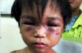 Bạo hành bé 3 tuổi: Khi vòng tay ôm là... tàn độc