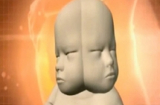Bào thai bé gái có hai mặt đối xứng, hai bộ não