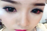 Hot girl Lily Luta viêm mắt nặng vì đeo kính áp tròng