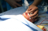 Phẫu thuật tách rời thành công cho hai bé sơ sinh dính liền
