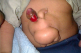 Phát hiện bào thai trong cơ thể bé trai