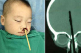 Cha mẹ bất cẩn, bé trai 2 tuổi bị đũa chọc từ mũi lên não