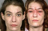 Cận cảnh những khuôn mặt biến dạng kinh hoàng vì dùng ma túy