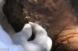 Bàn chân biến dạng kinh hoàng vì cả trăm con bọ chét làm tổ