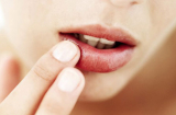 4 cách để môi không bị chảy máu trong mùa đông