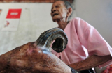 Kỳ lạ cụ bà 97 tuổi mọc sừng dài 20cm ở chân