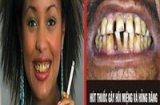 Cận cảnh sự phá hoại kinh hoàng vì thuốc lá tới hàm răng