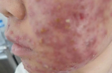 Kinh hoàng: Mặt nát bét vì uống collagen làm đẹp da
