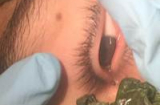Kinh hãi dòi dài 3 cm làm tổ trong mắt thanh niên suốt 1 tháng