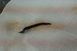 Kinh hoàng: Gắp con đỉa 4,5cm trong mũi bệnh nhân