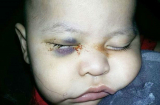 Bác sĩ phẫu thuật nhầm, bé trai 1 tuổi bị mù mắt