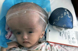 Bé gái đầu tiên trên thế giới được ghép sọ làm bằng in 3D
